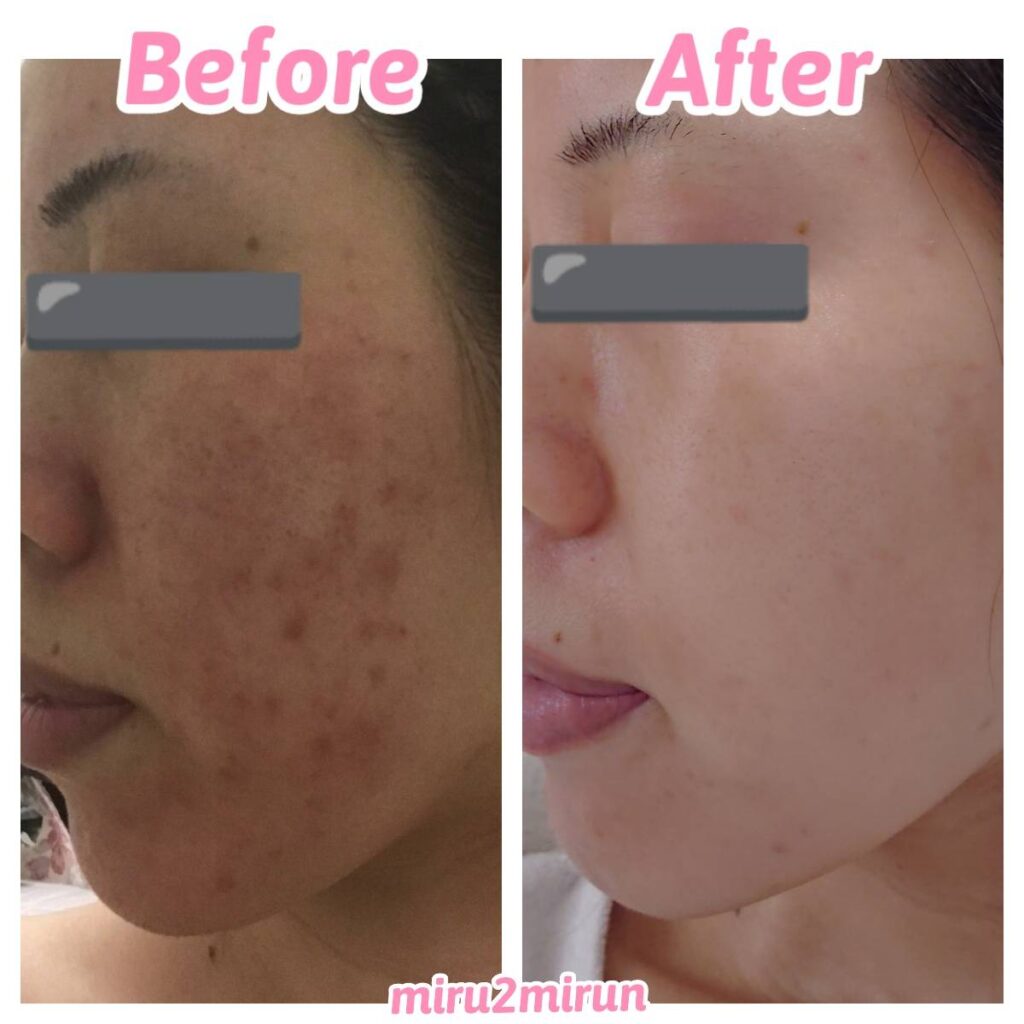 skin-before-after