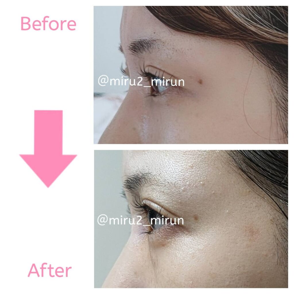 facial_blemishes_age_spot_before_after
