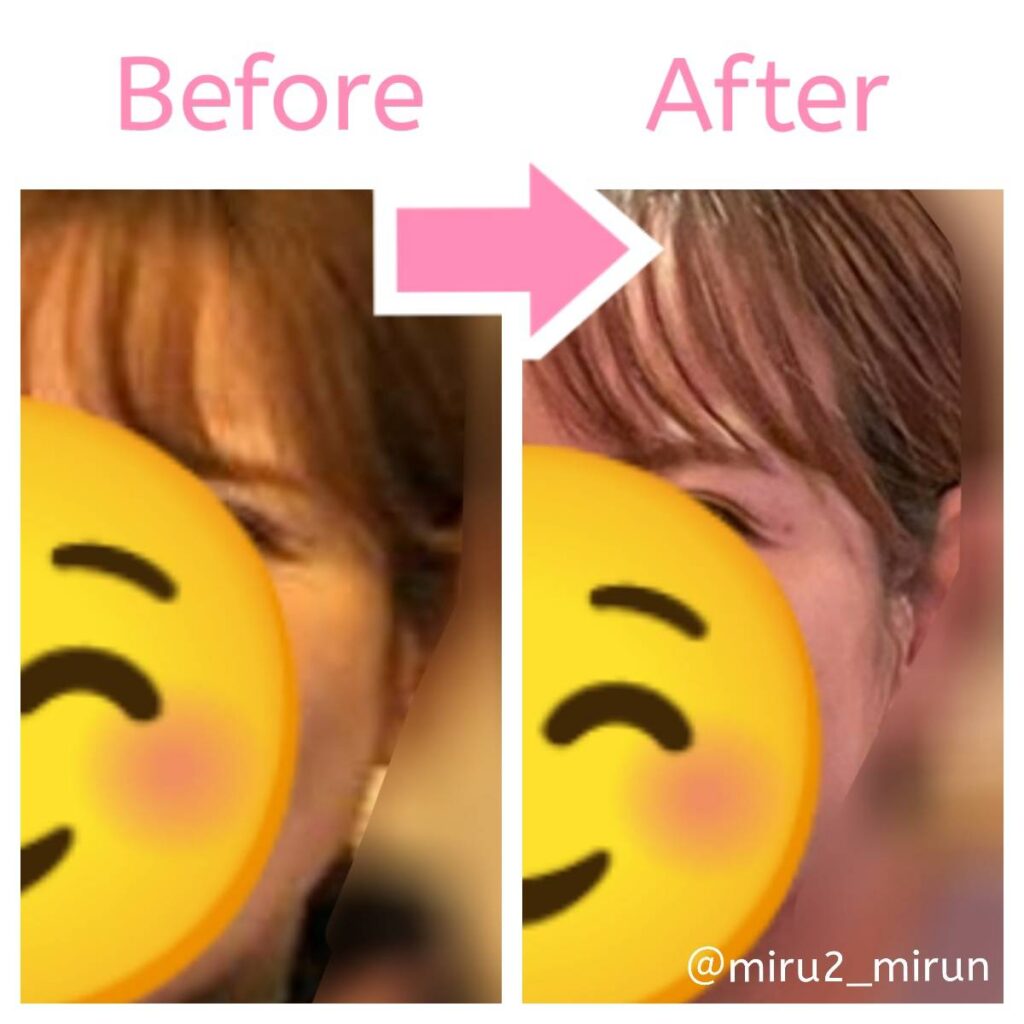 facial_blemishes_age_spot_before_after_2