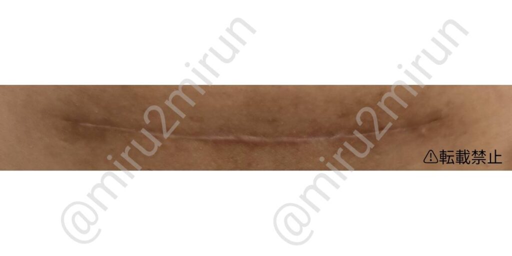 cesarean_section_postoperative_photo_2