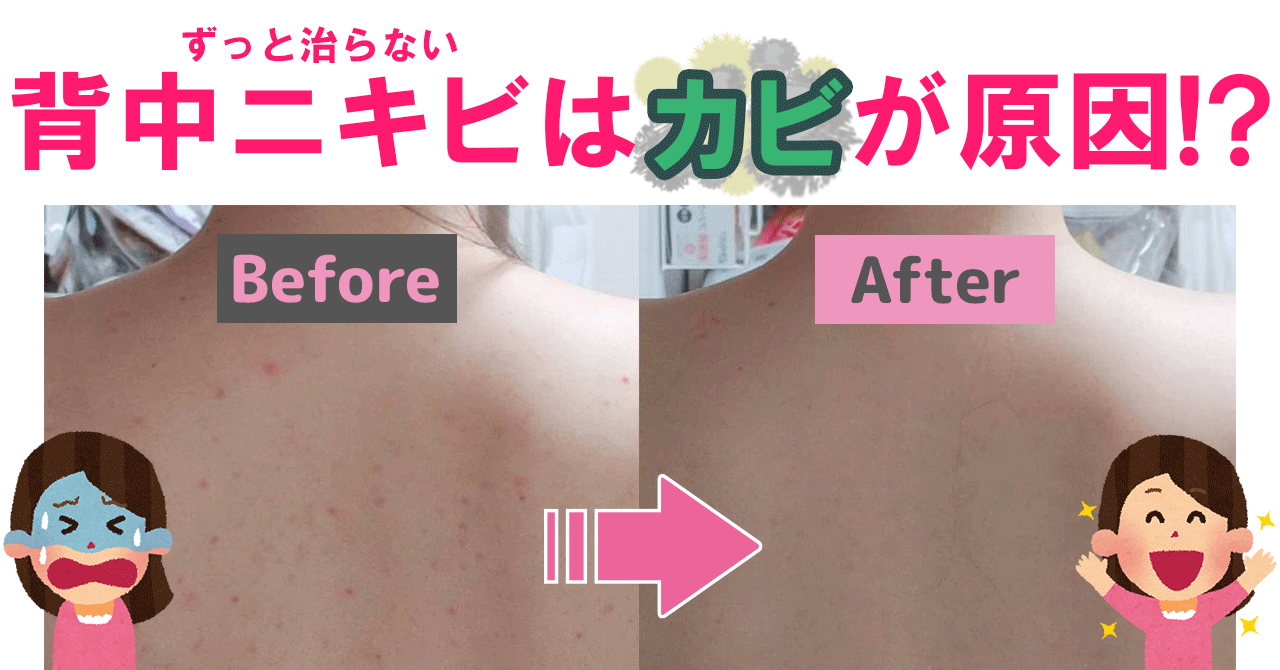 back_acne_treatment_incurable_malassezia_folliculitis